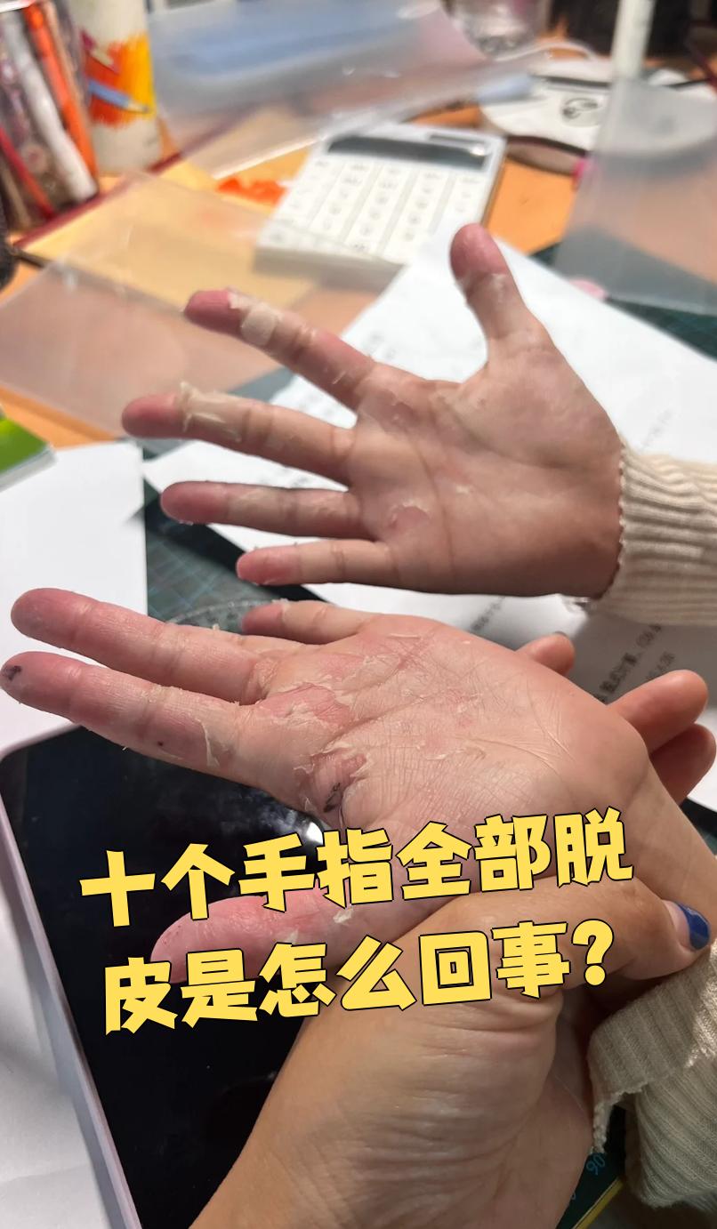 手指脱皮不痒不痛只脱皮百科在线