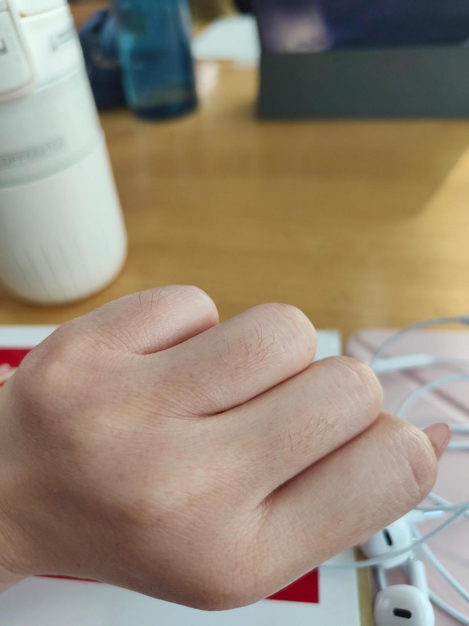 手背上的小红点 早上起来左手手背突然起了很多小红点,不痛不痒,半年