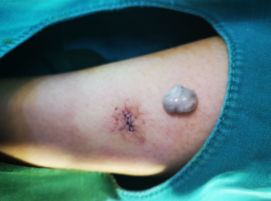 皮肤纤维瘤是一种良性肿瘤,主要是真皮内的成纤维细胞或组织细胞