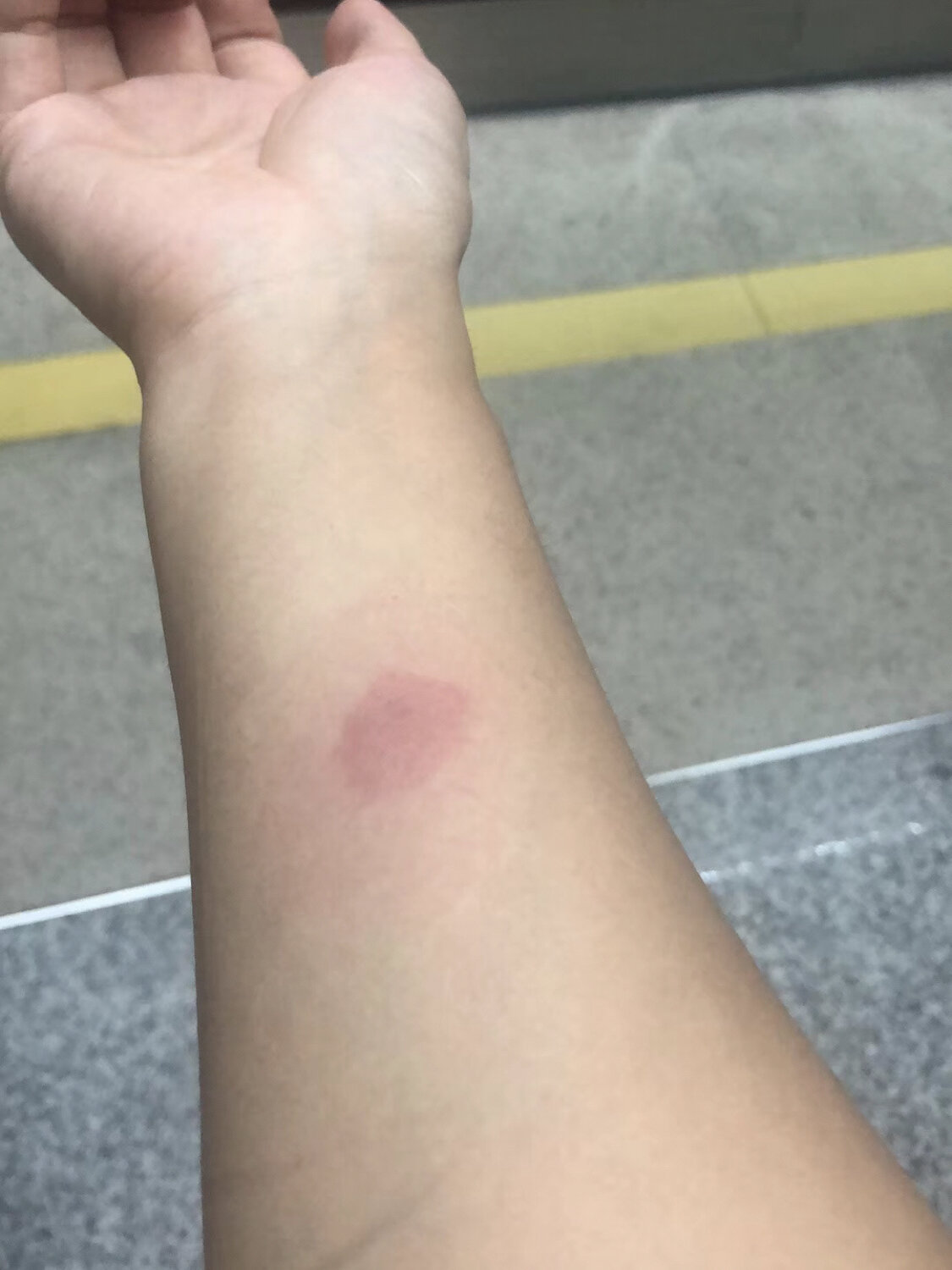 这一下就不得了要吃了18个月的盆腔结核治疗,无奈相信医生乖乖吃完20