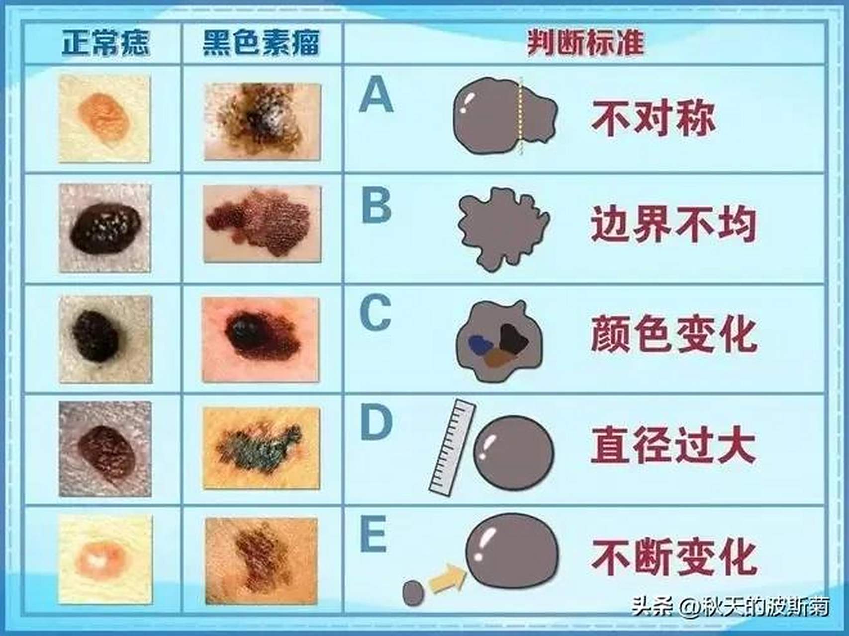 我们每个人身上都长得有痣和一些黑色素瘤,大部分都是正常的,但也有一