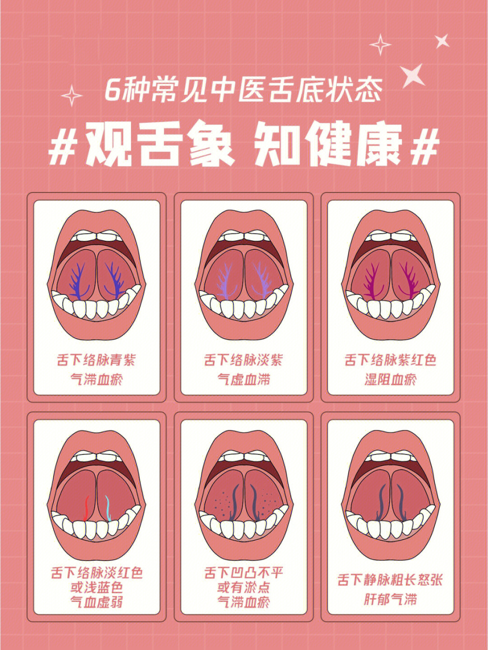 赶快收藏自测 总之,舌下络脉的颜色变化,实则色深,虚则色淡.