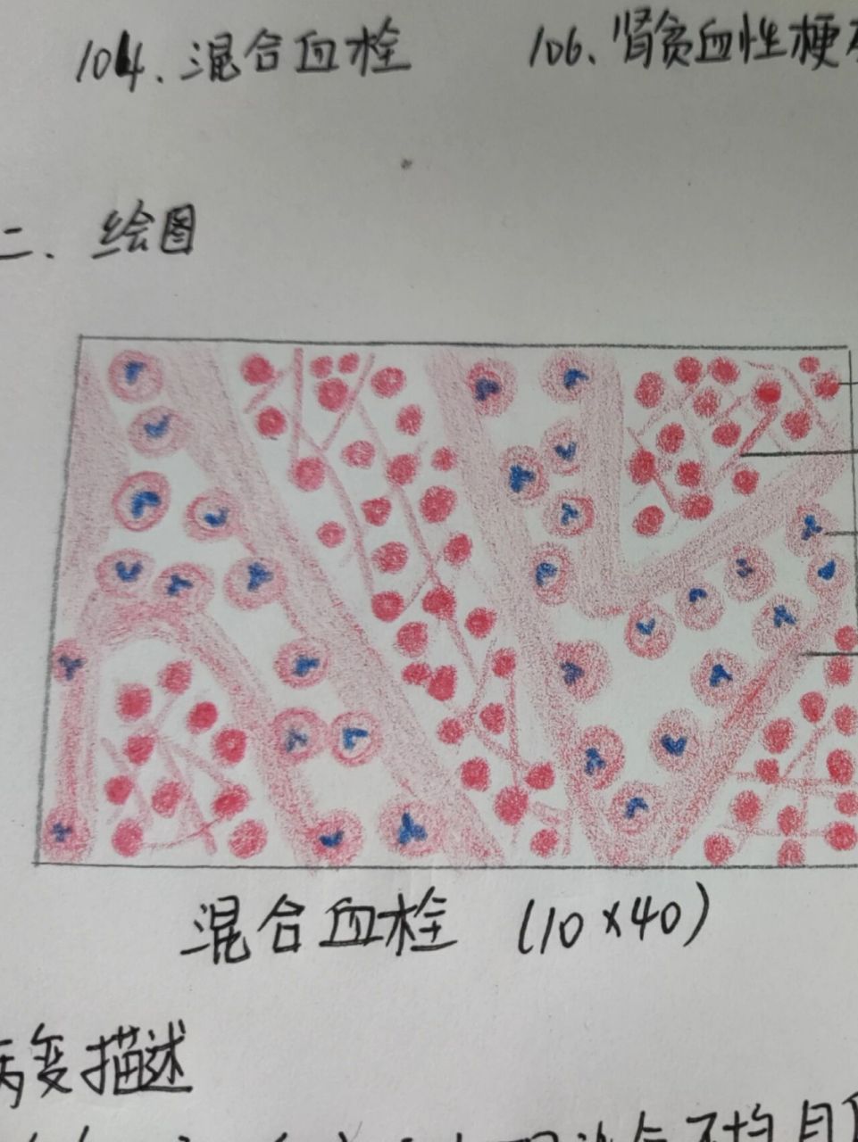 病理学 混合血栓红蓝铅笔绘图