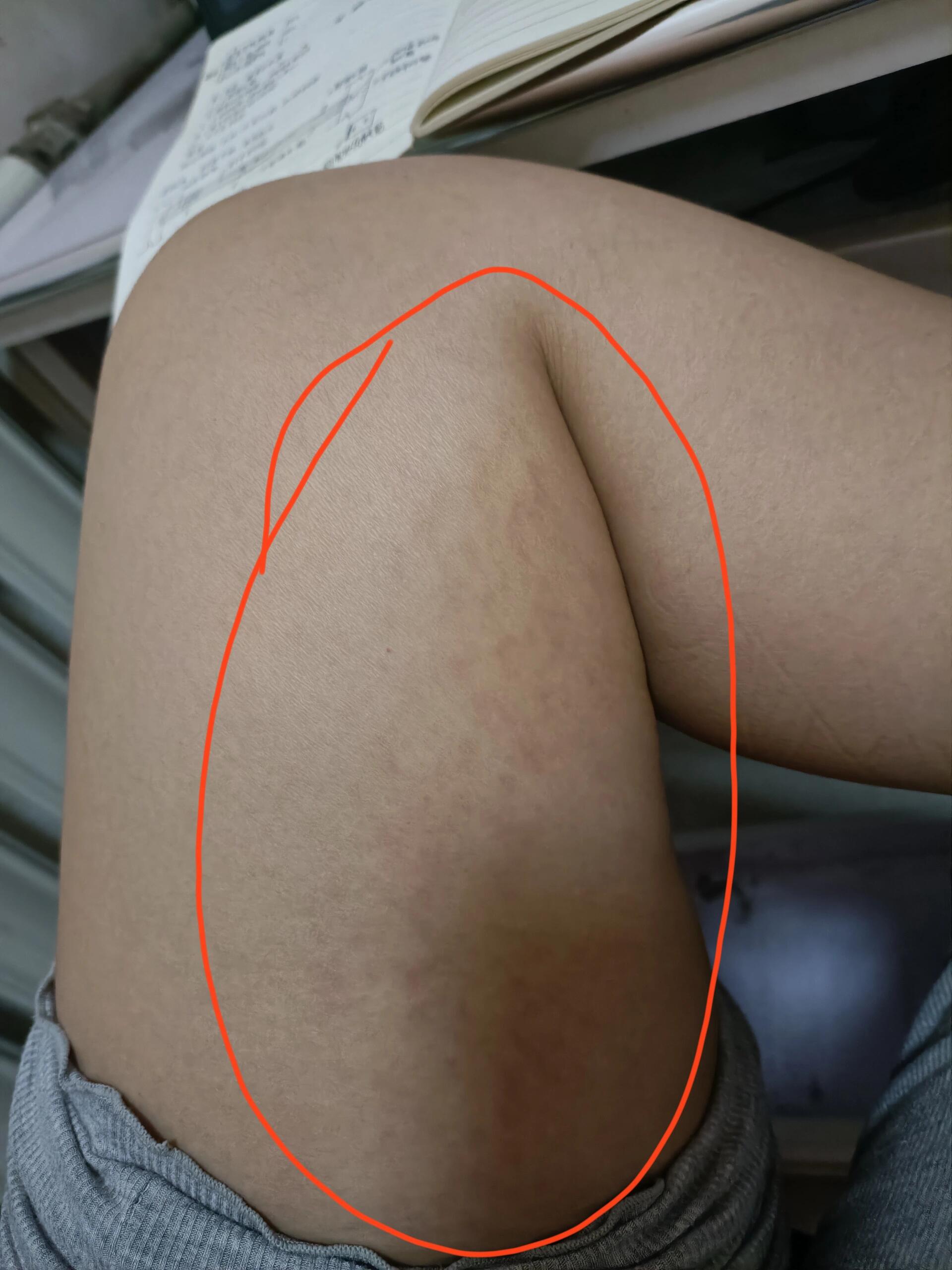 产后三个月了,最近发现大腿内侧好多红道道,和妊娠纹有点像,但是摸