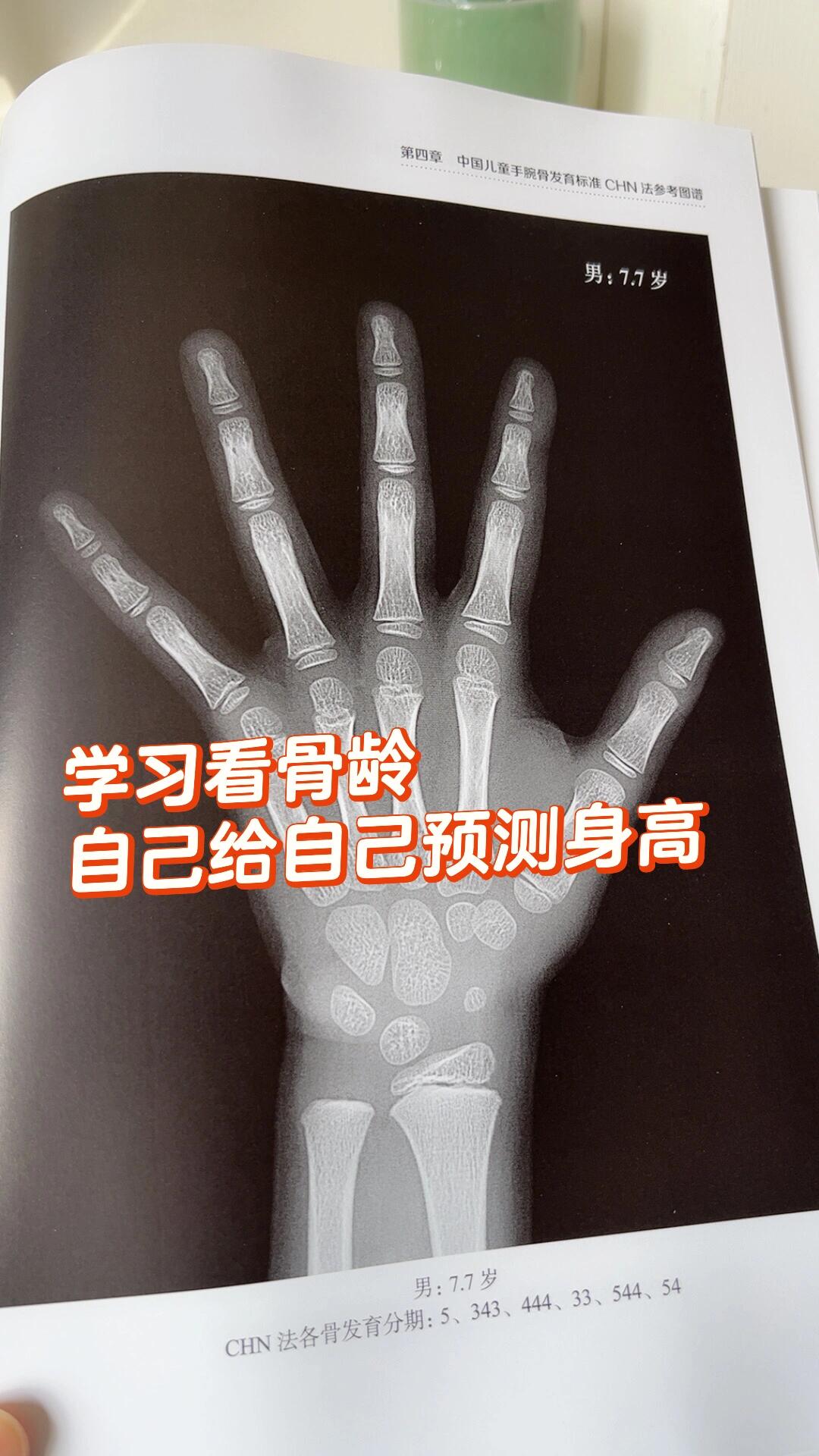学会看骨龄,去医院拍个骨龄自己都能预测身