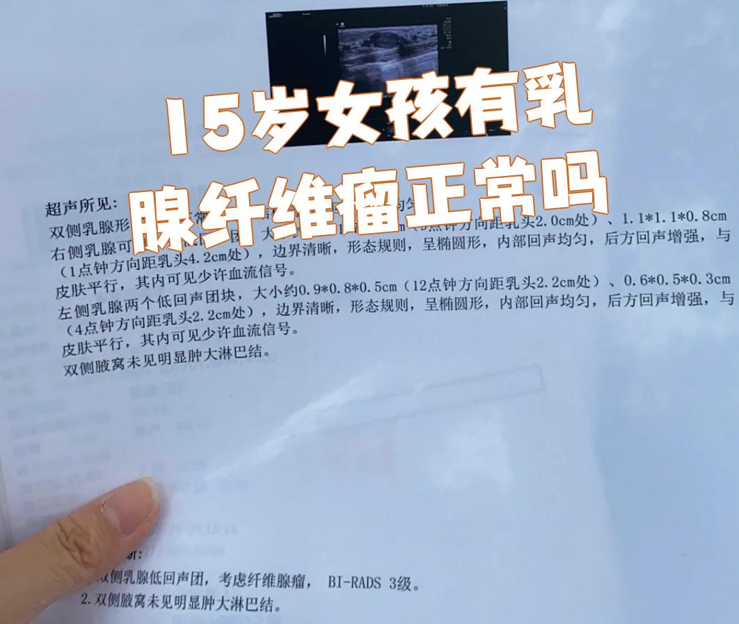是乳腺小叶内纤维组织和腺上皮的良性肿瘤,也是乳腺最常见的良性肿瘤