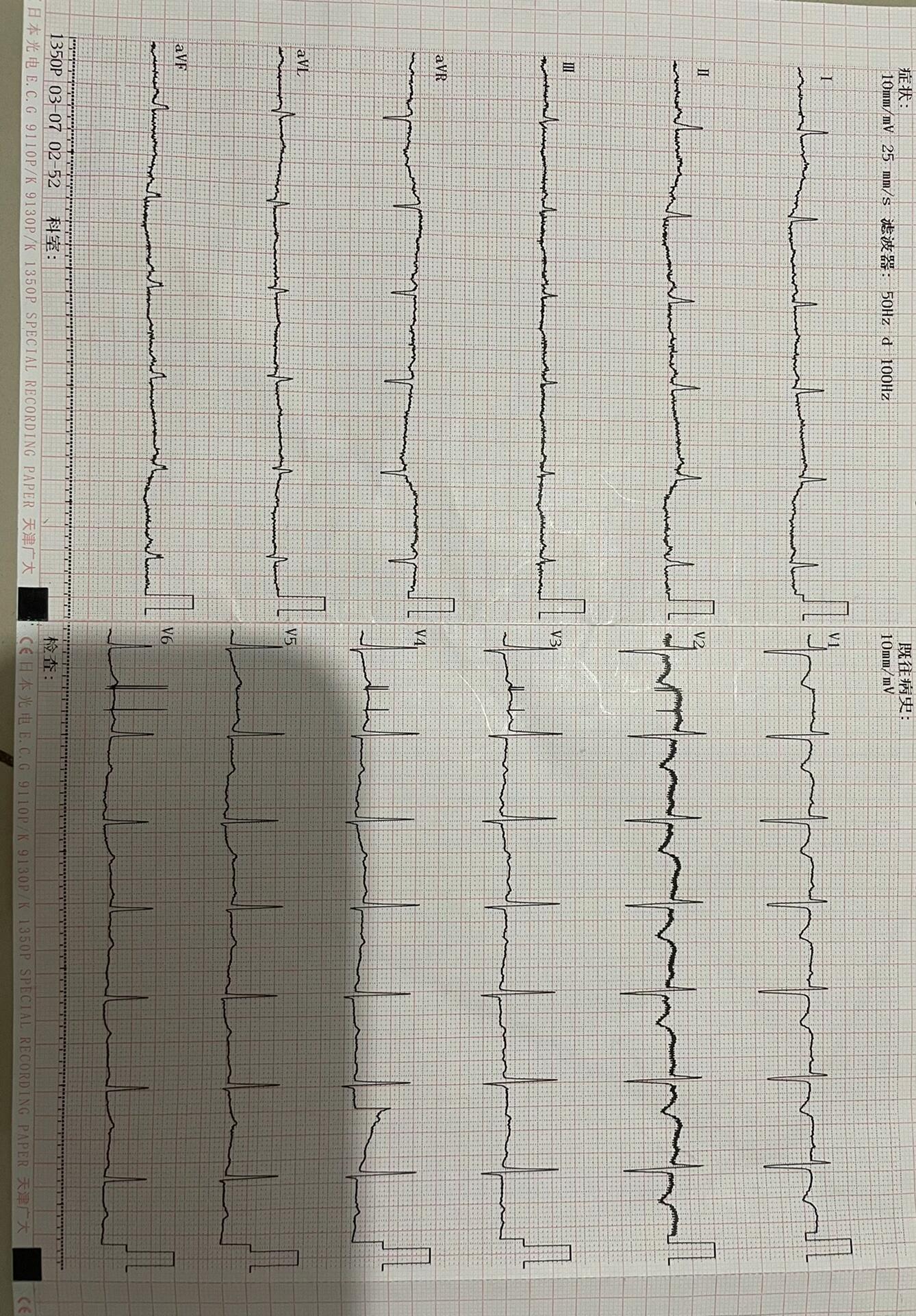 心电图-非特异性t波异常 头晕查个心电图,一个医生说没事,一个医生说