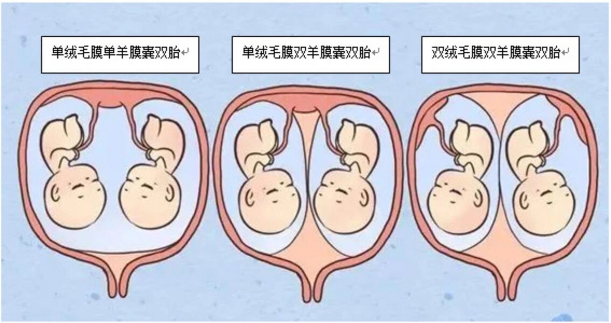 异卵双胞胎怀孕卡通图片