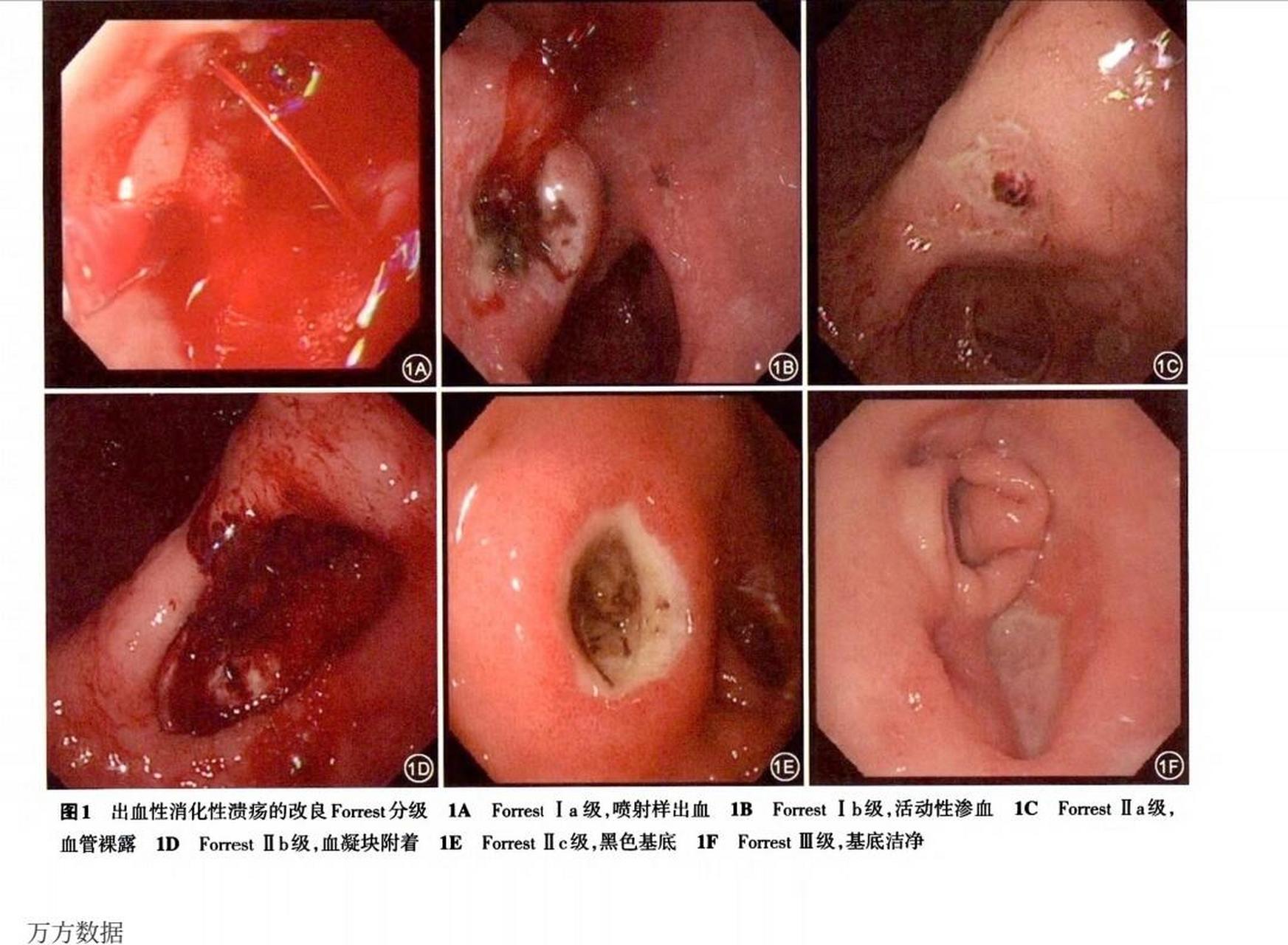 肝硬化消化道出血图片