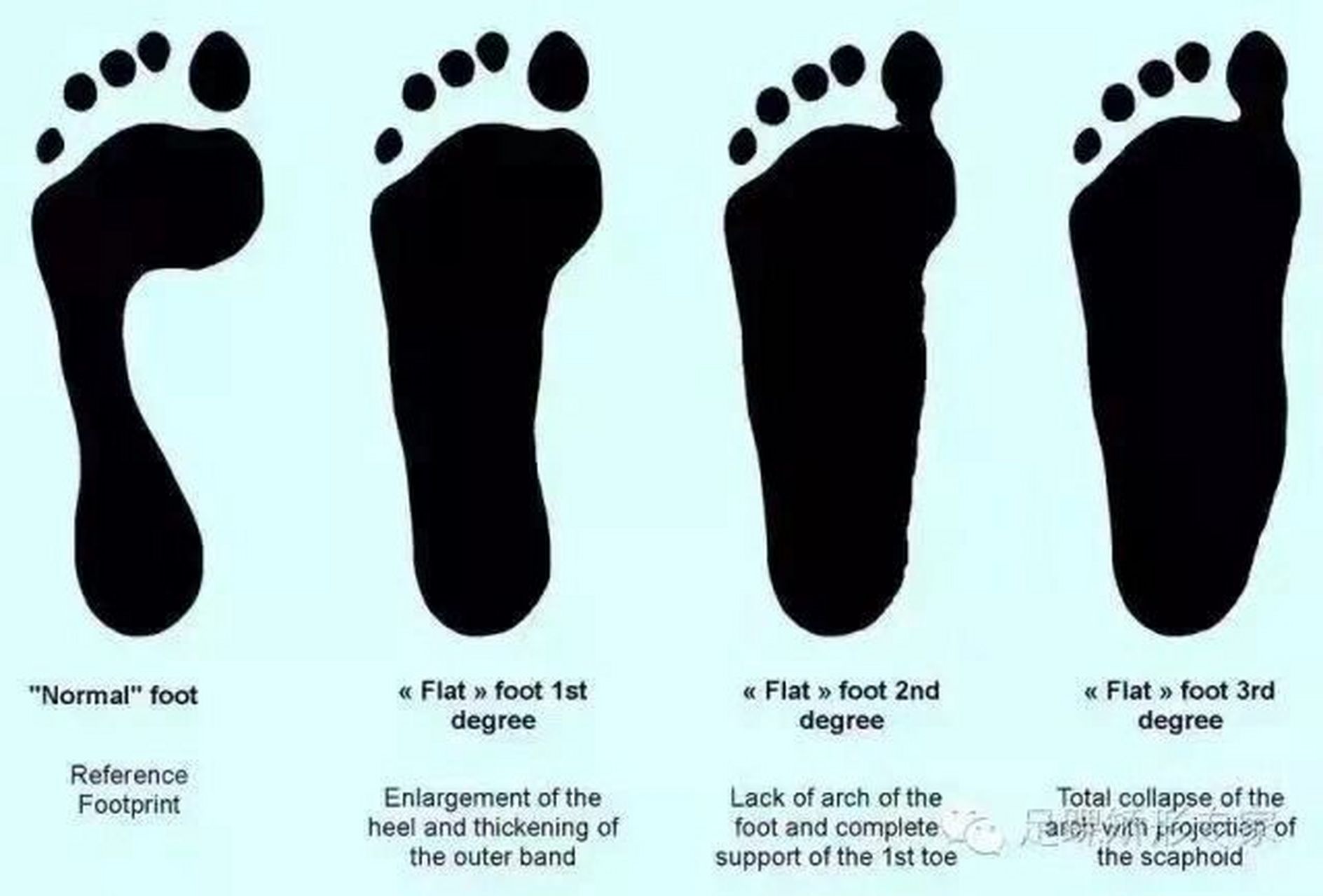 21/带你深度认识扁平足 扁平足又称平足(flatfoot),平板脚,扁平外翻足