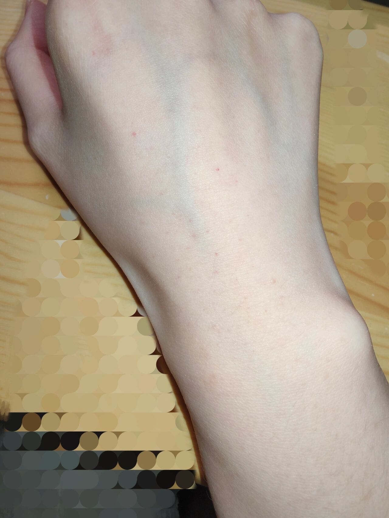 阳了之后手背有小红点不痛不痒 家人们这是什么情况 之前发烧时也出过