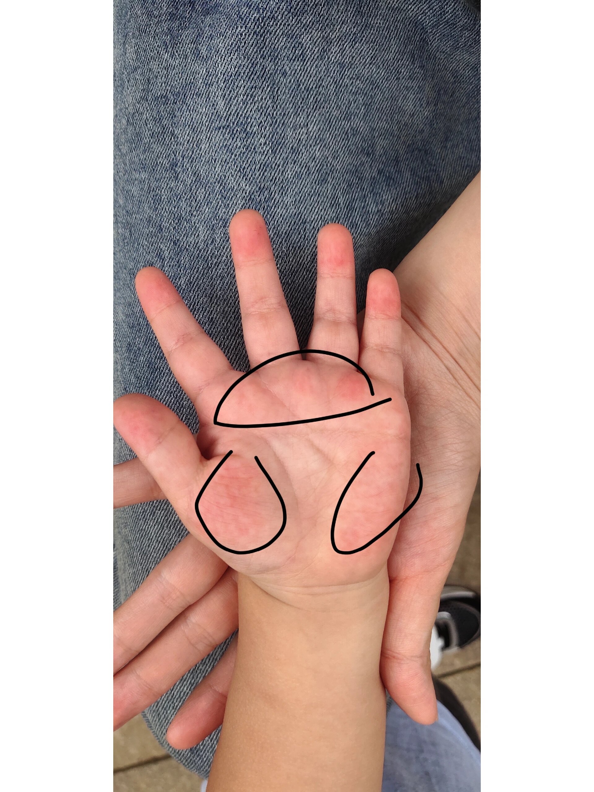 小孩子手掌发红.他这个手掌是正常的吗?