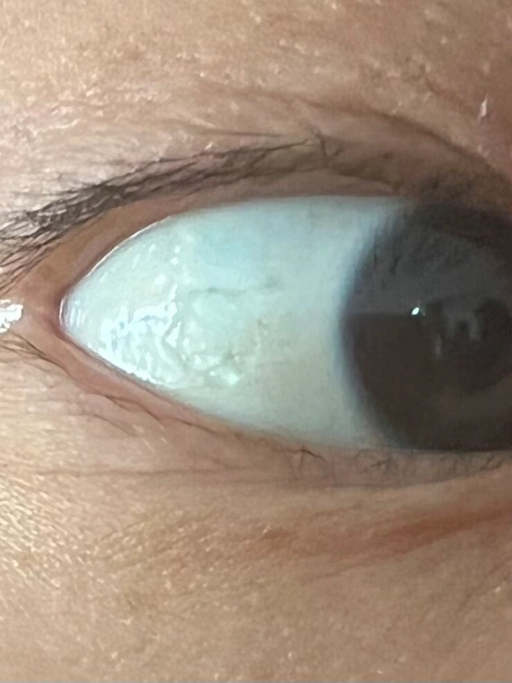 肉眼可见的 眼角膜起褶皱了