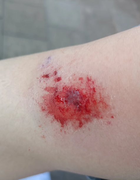 🎀🎀如果是血液渗出,这很正常.因为摔伤时血管破了,皮肤也有损