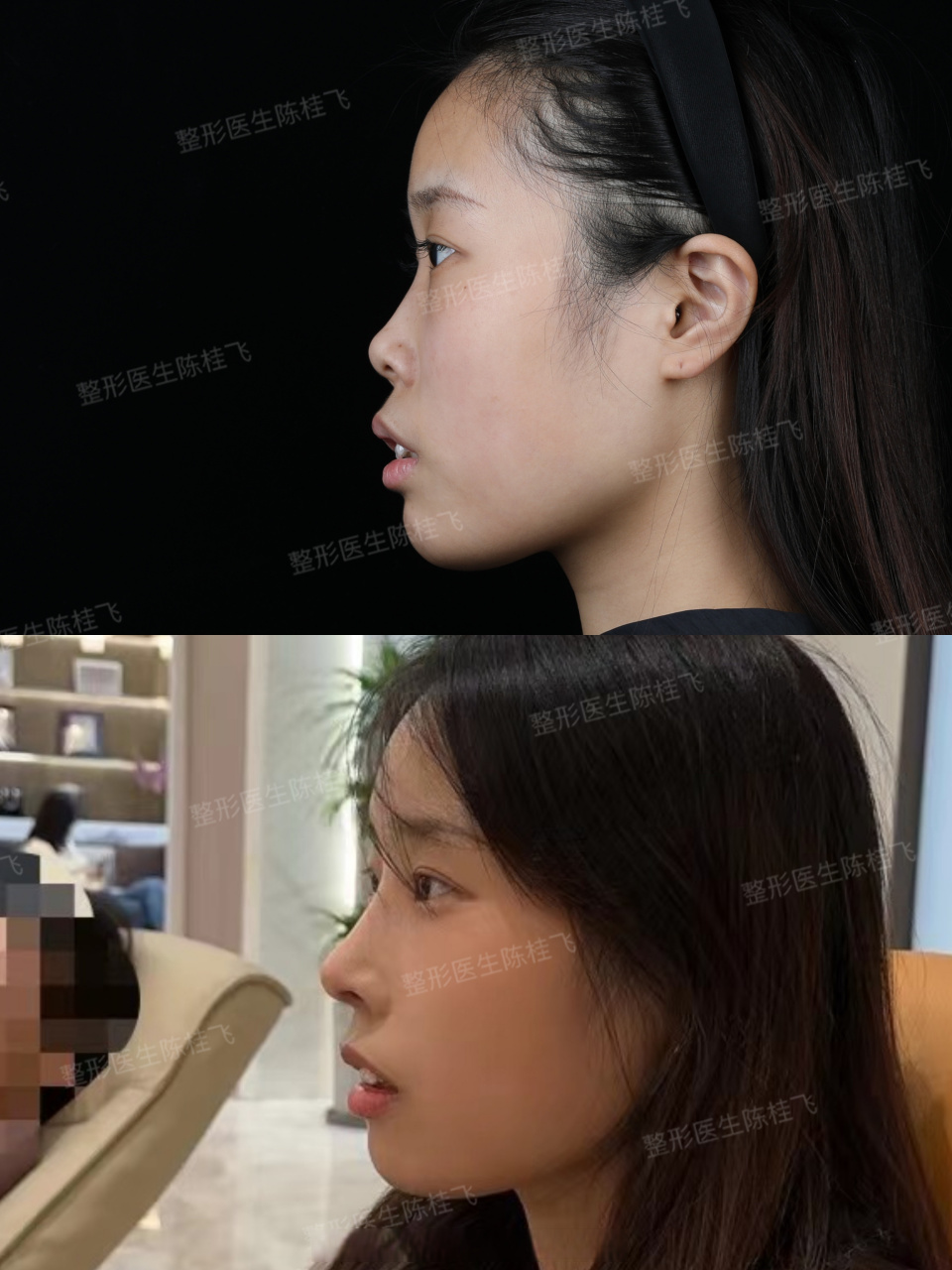 肋软骨鼻综合,月亮脸的改善,术后一个月回来做皮肤,美丽不止步!