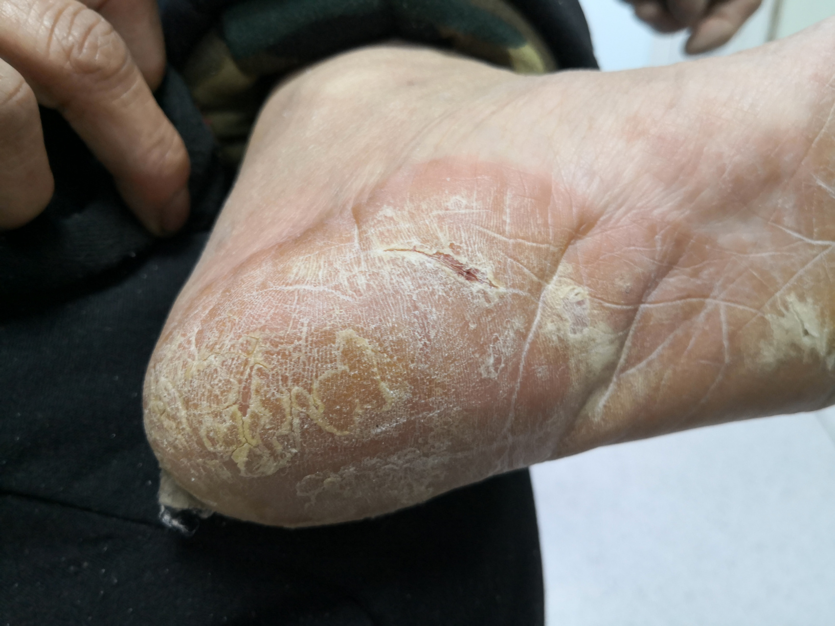 手足角化型湿疹症状#湿疹