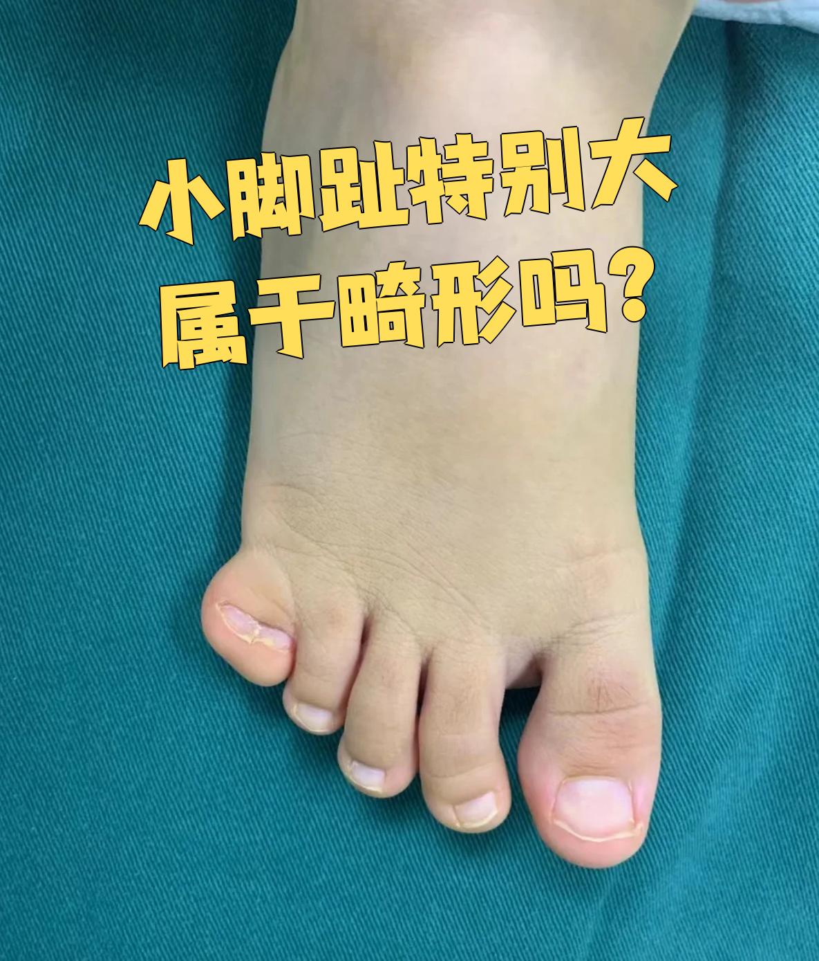 小脚趾特别大一般属于畸形