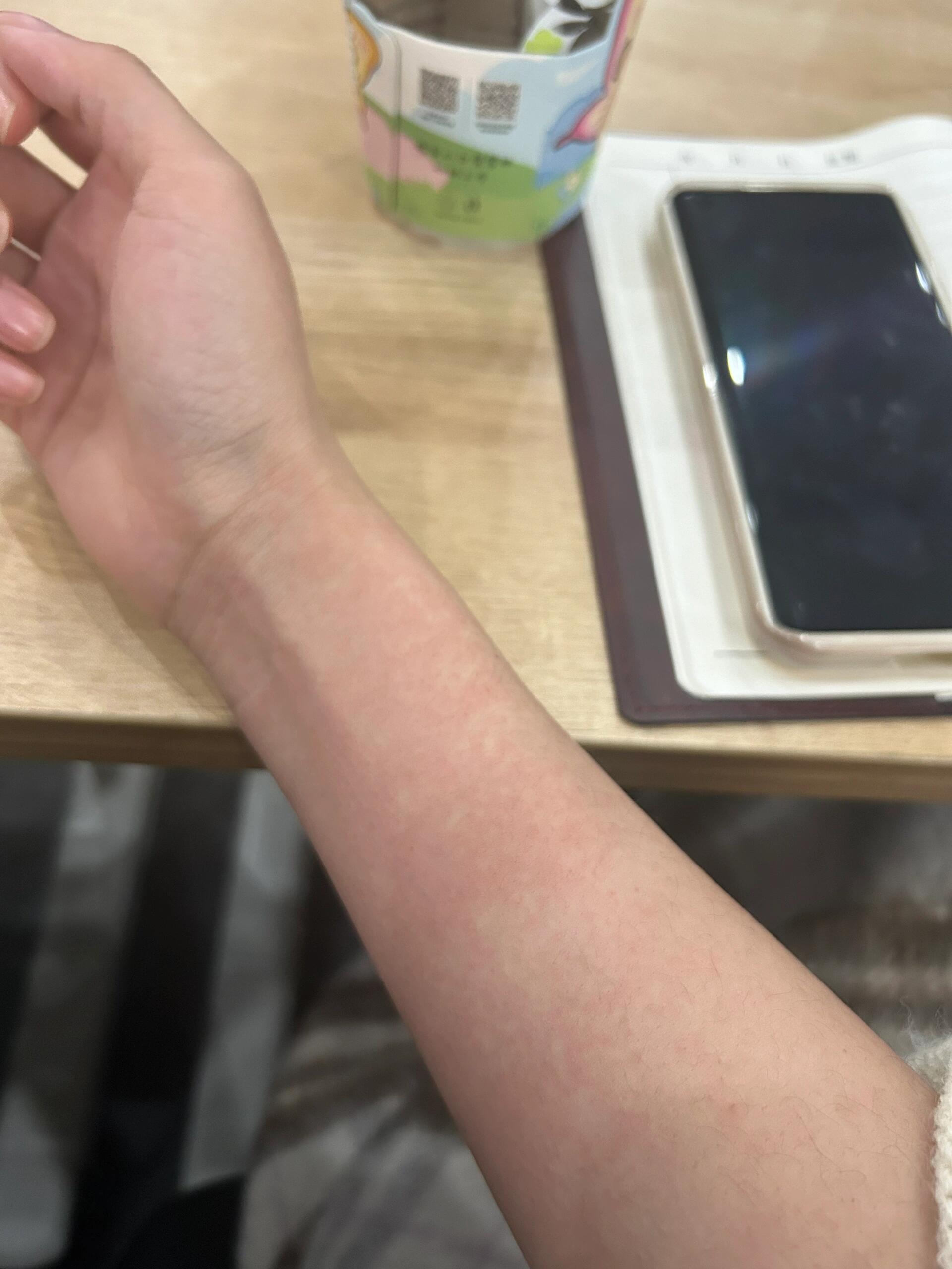 酒精过敏 医生:知道自己什么过敏么 我:知道 酒精 医生:那你还喝 我
