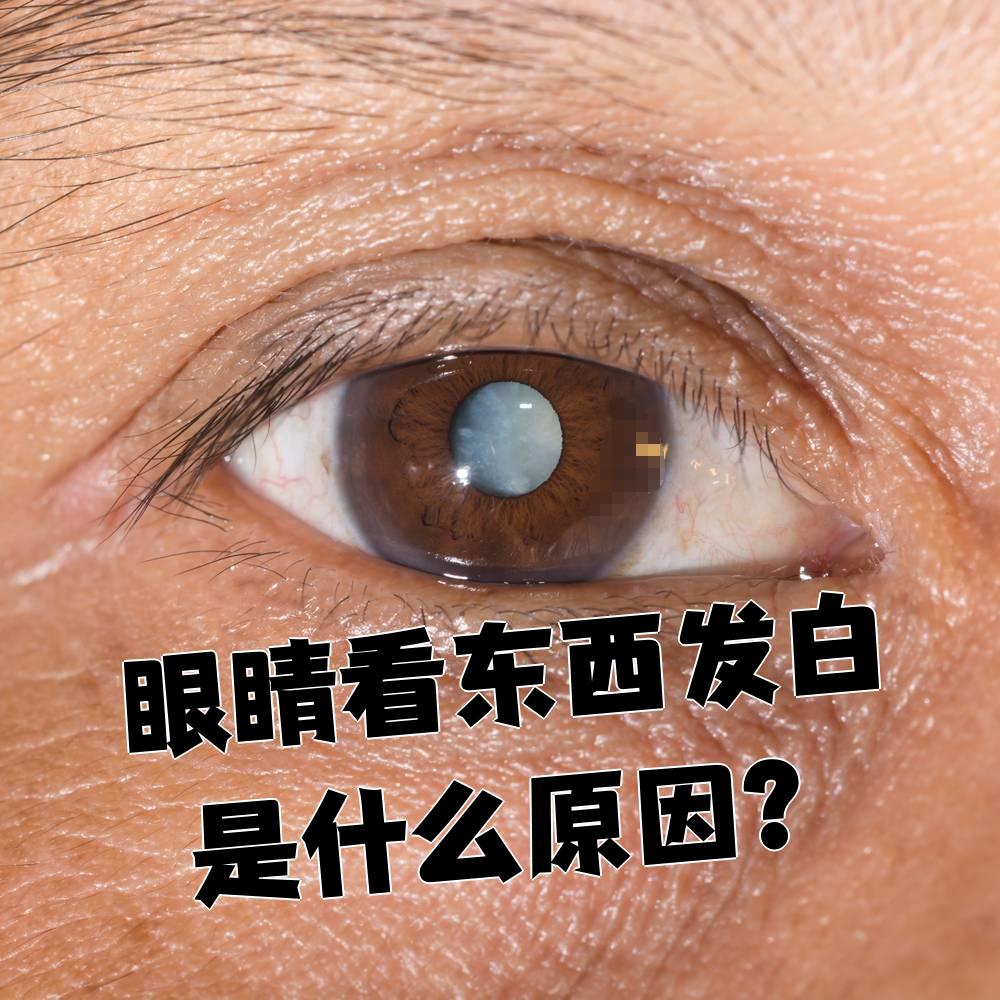 眼睛看东西发白最常见的原因是眼底病变或白内障