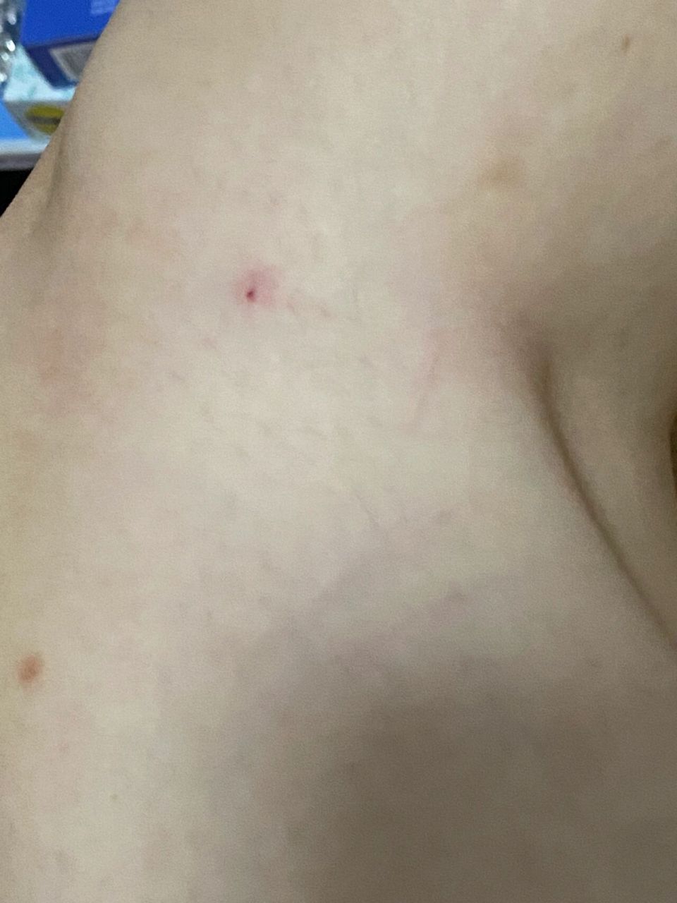 已经拿肥皂水和酒精消毒过了 明天打算去捡点专门被猫抓伤中药回来煲