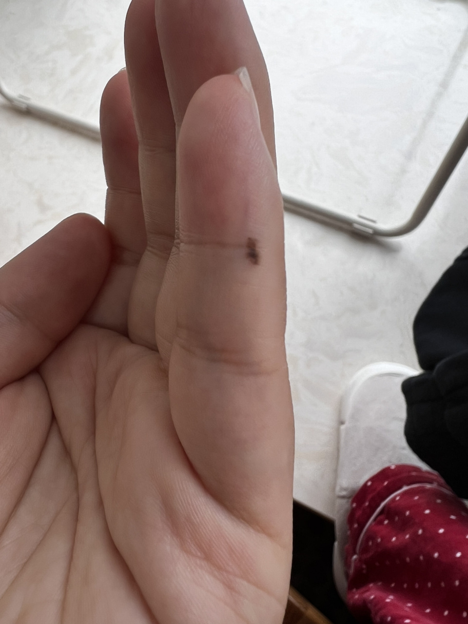 在刷某音的时候突然看到了关于黑色素瘤 瞬间就看到了自己手上的这一
