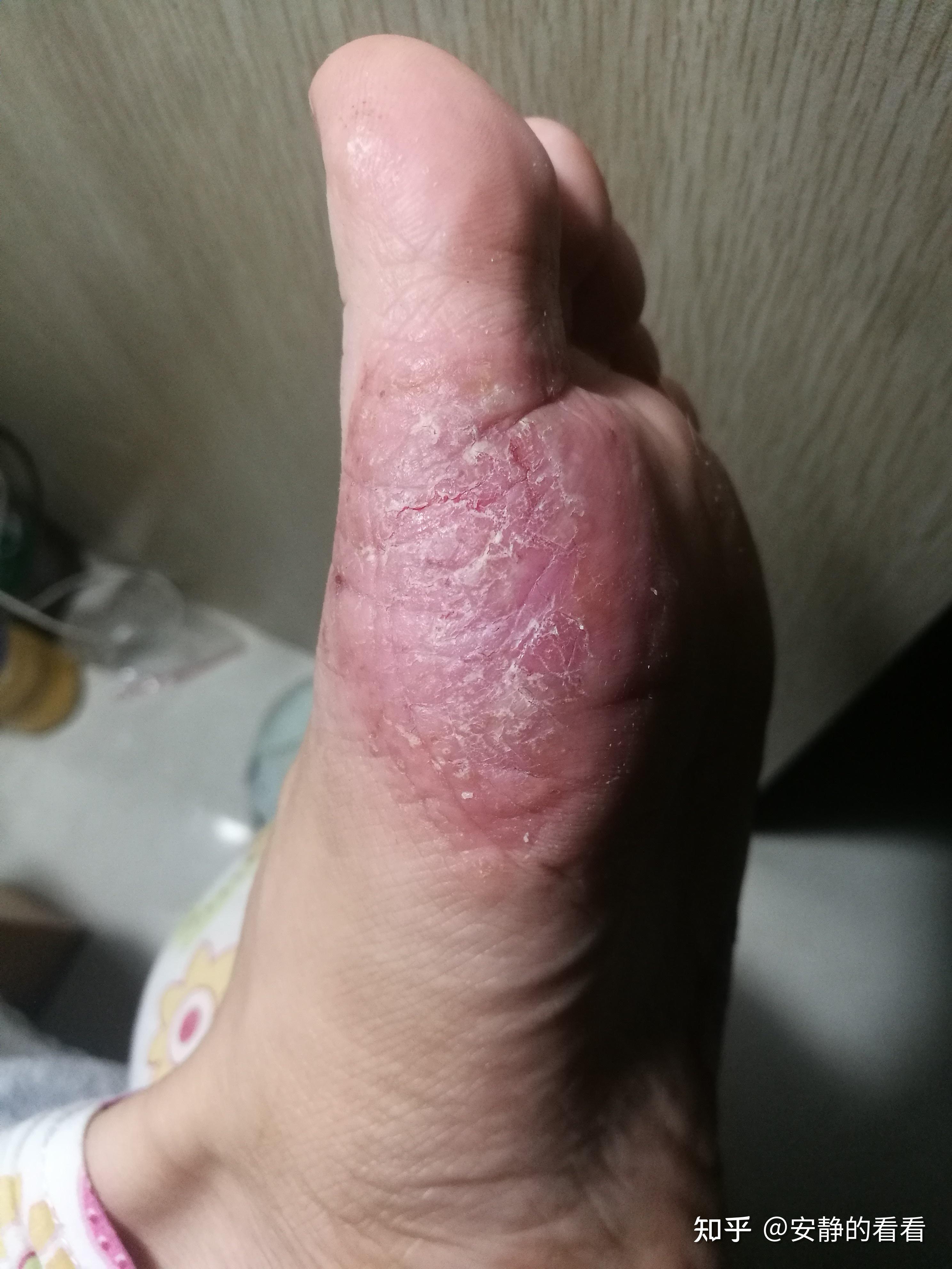 汗疱疹小水泡不花钱就能从根本上痊愈