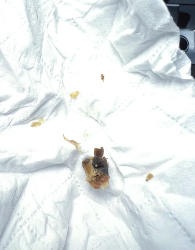 耳屎发黑可能没什么问题,但也可能是某些疾病引起的,比如耵聍栓塞