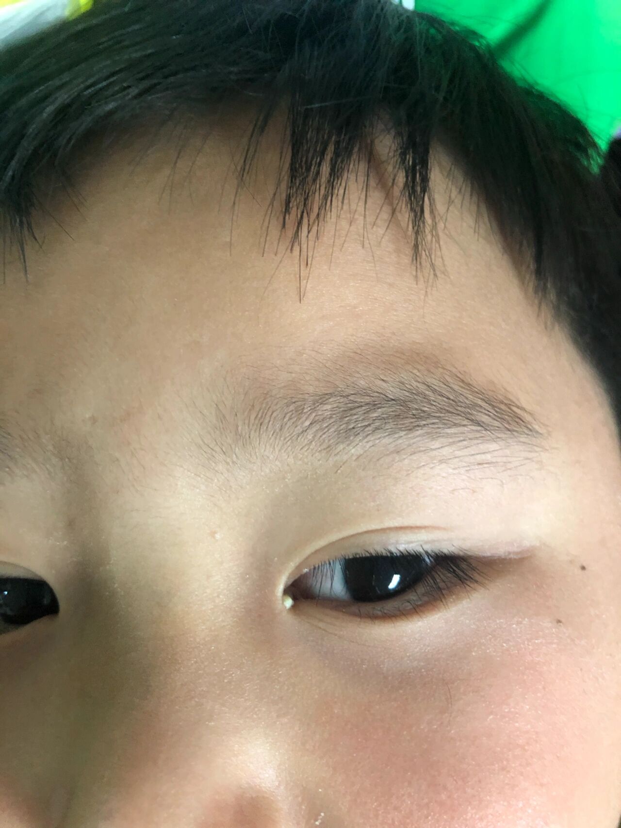 小孩子眼睛一直出眼屎 不知道宝宝这次是否是急性结膜炎,还是其他