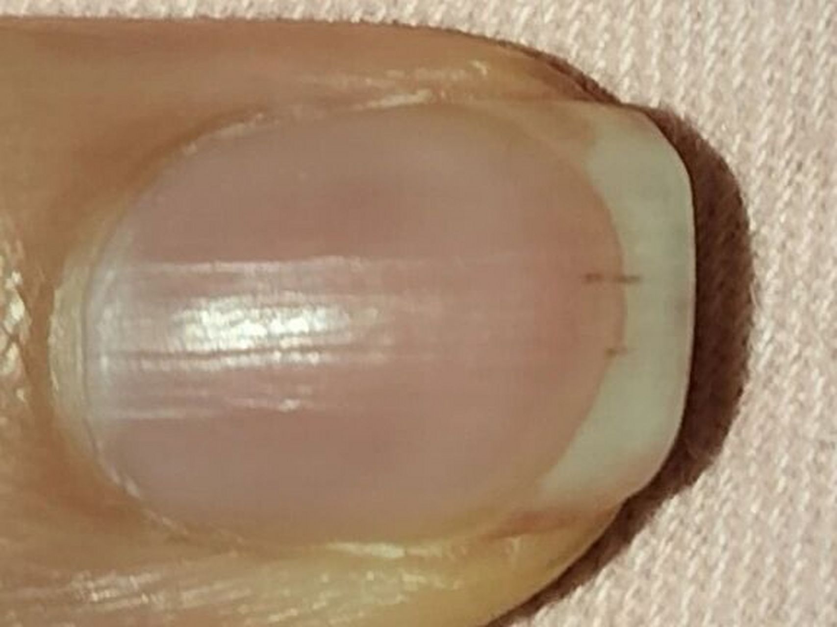 指甲上有两条黑线,图一是昨天早上拍的,图二今天下午拍的,这是咋了