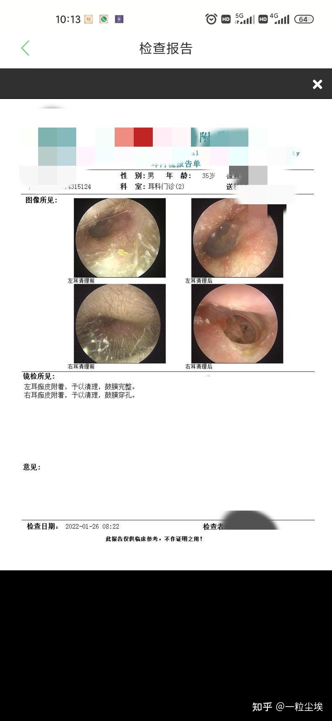 中耳炎手术从哪里开刀图片