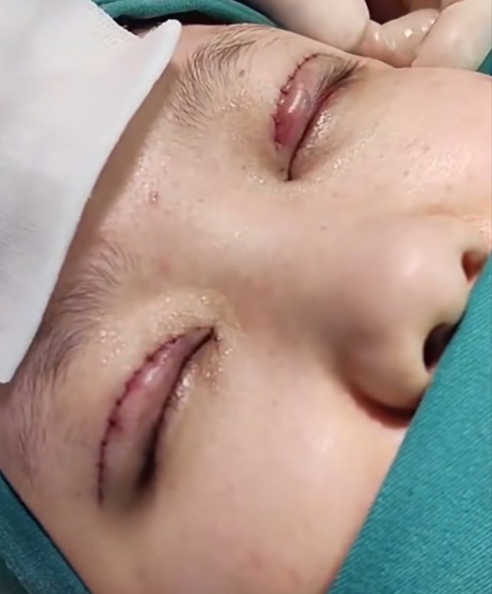 纳米无痕双眼皮手术不用切开皮肤,只要做几个小切口就能完成