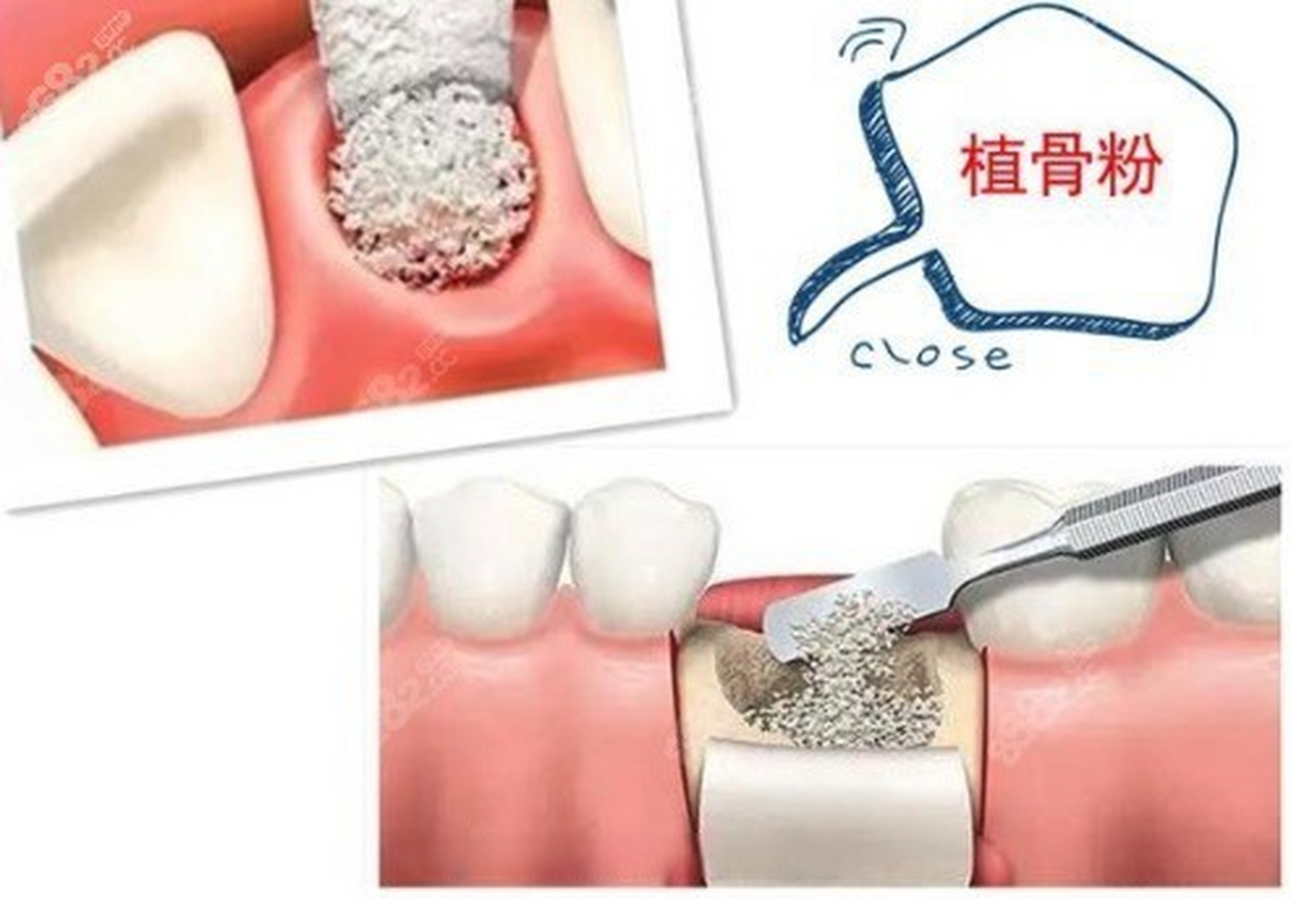 种植牙一定要进行植骨吗?