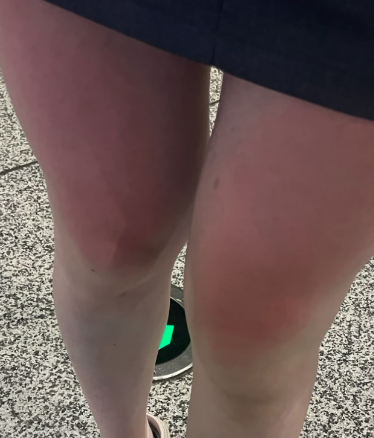 晒伤是因为皮肤被紫外线灼伤,所以外出时要穿长裤或打伞,避免太阳直射