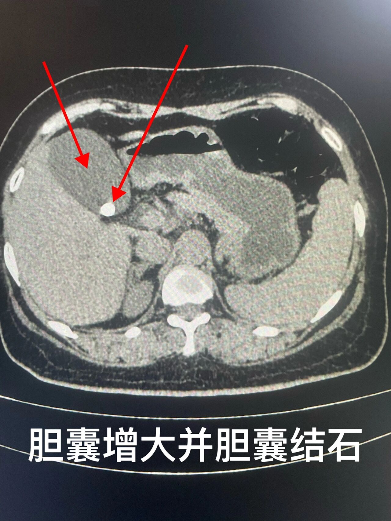 胆系结石(上腹部ct平扫)胆囊 胆系结石的ct表现💕💕💕  平扫