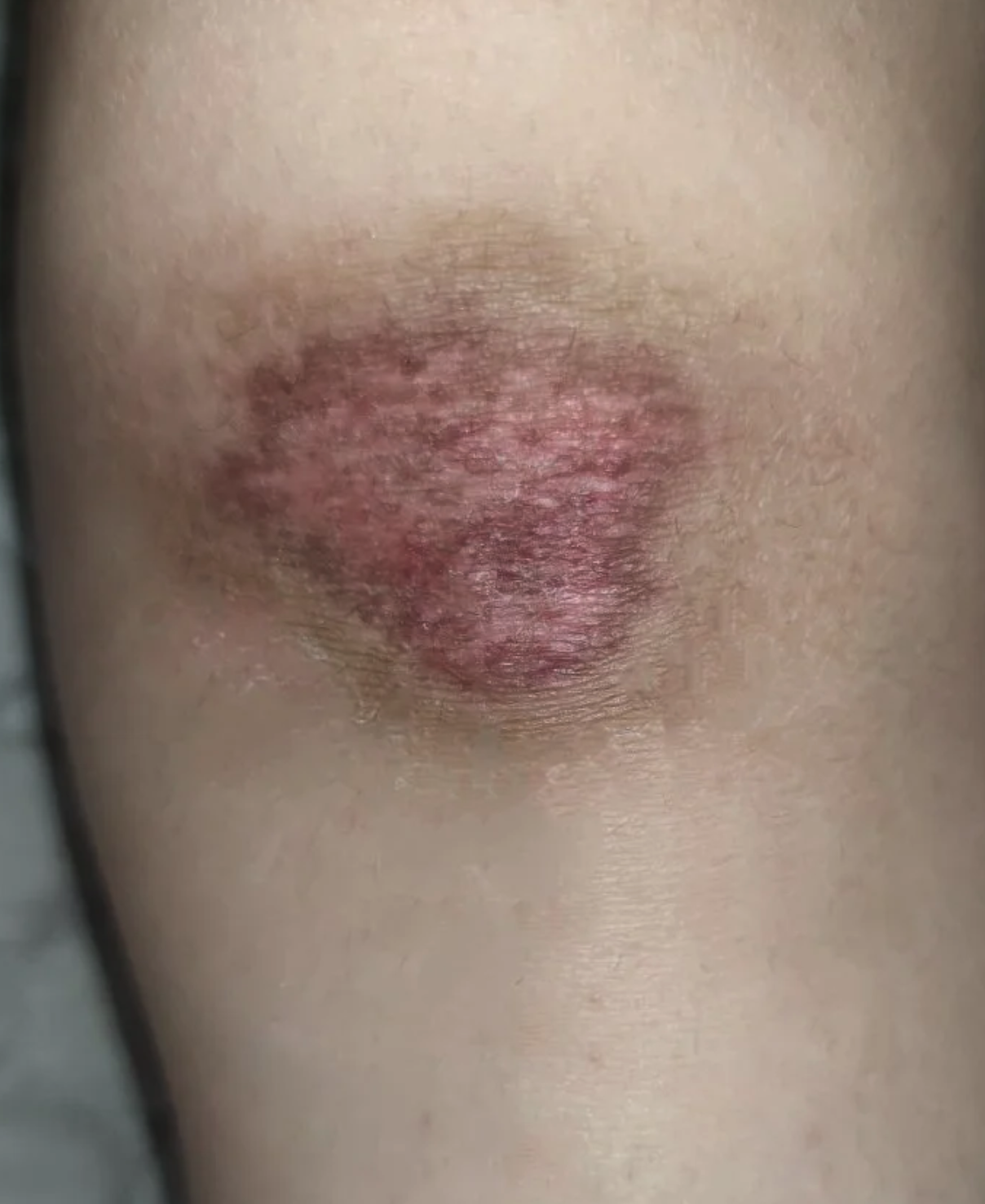 擦伤后留下的疤痕恢复时间因人而异,通常需要半个月到一个月才能