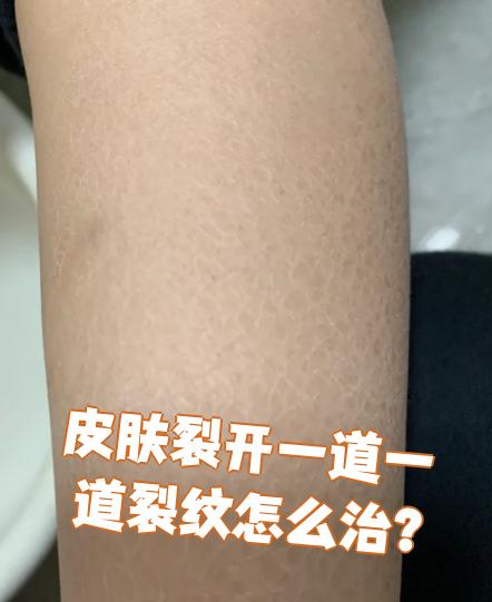 皮肤裂开一道一道裂纹需要根据具体原因治疗