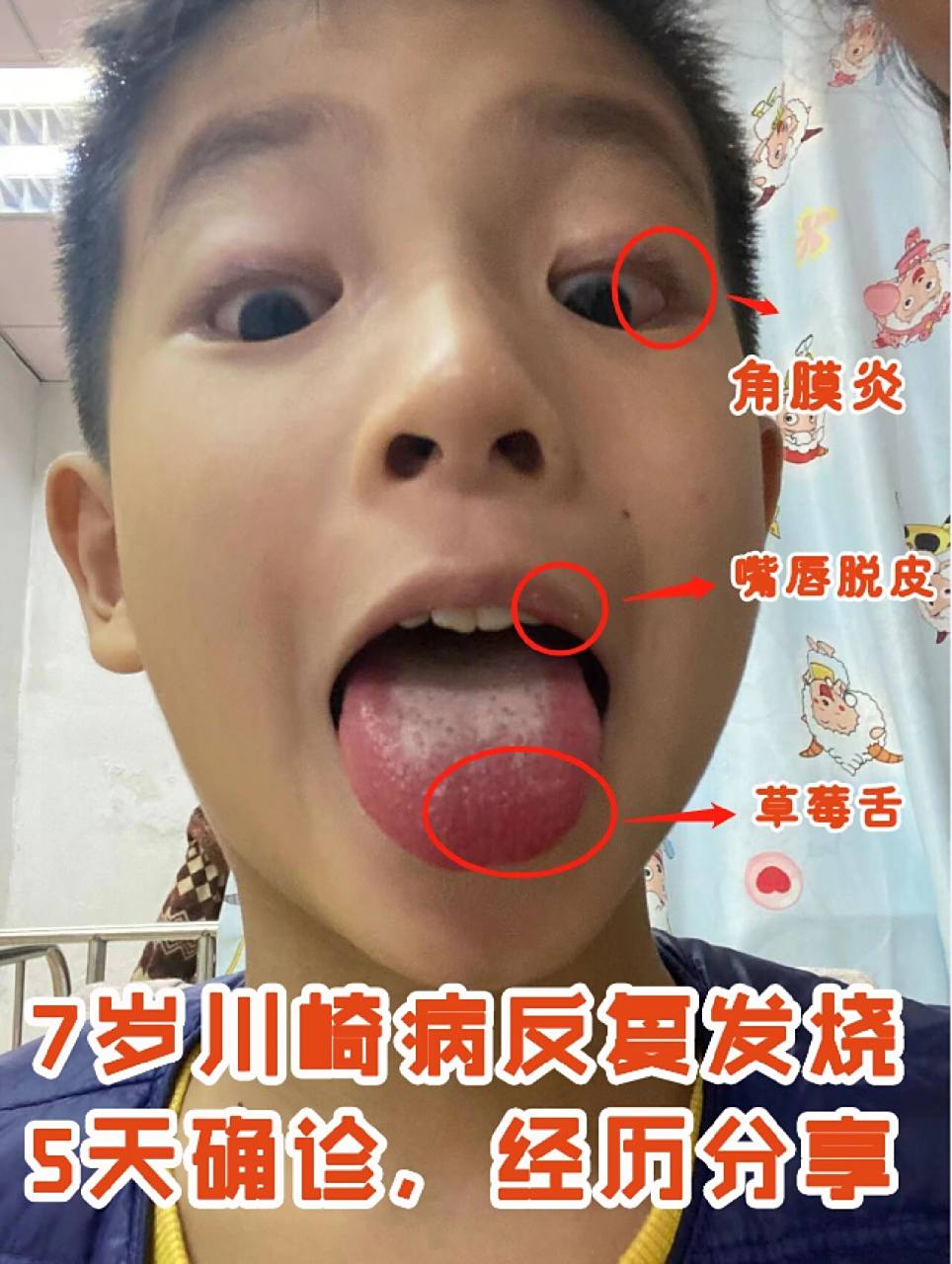 7岁川崎病反复发烧,5天确诊,经历分享  74时间段: 11月19日下午