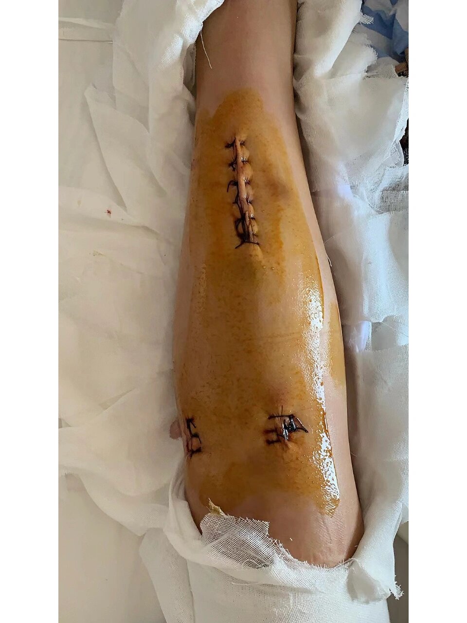 胫腓骨骨折第13天 弹性髓内钉术后第6天