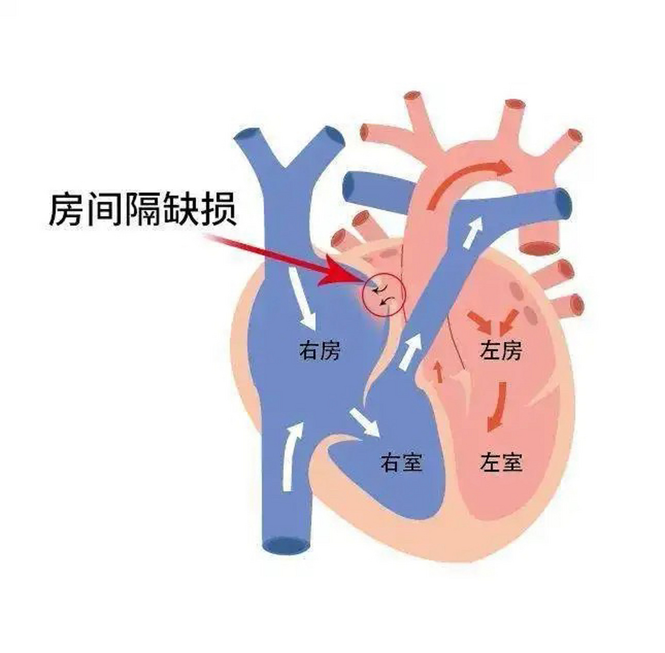 房间隔缺损侧切手术相对简单,主要方法有体外循环,心脏骤停和心脏直视