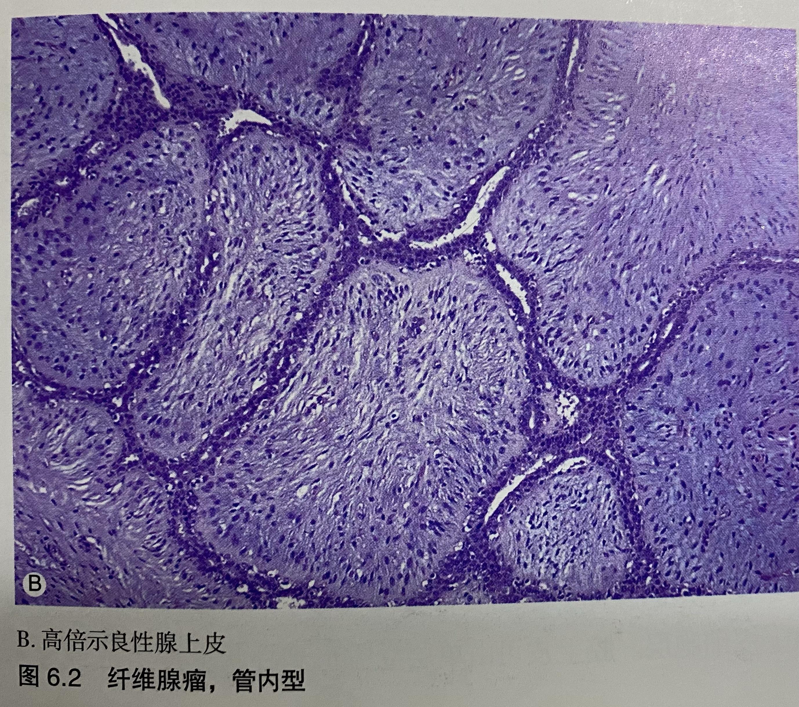 乳腺纤维瘤图片库图片