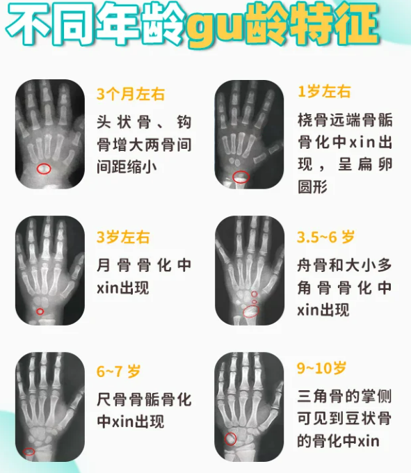 给孩子测骨龄最常用的方法是拍左手和腕部的x光片