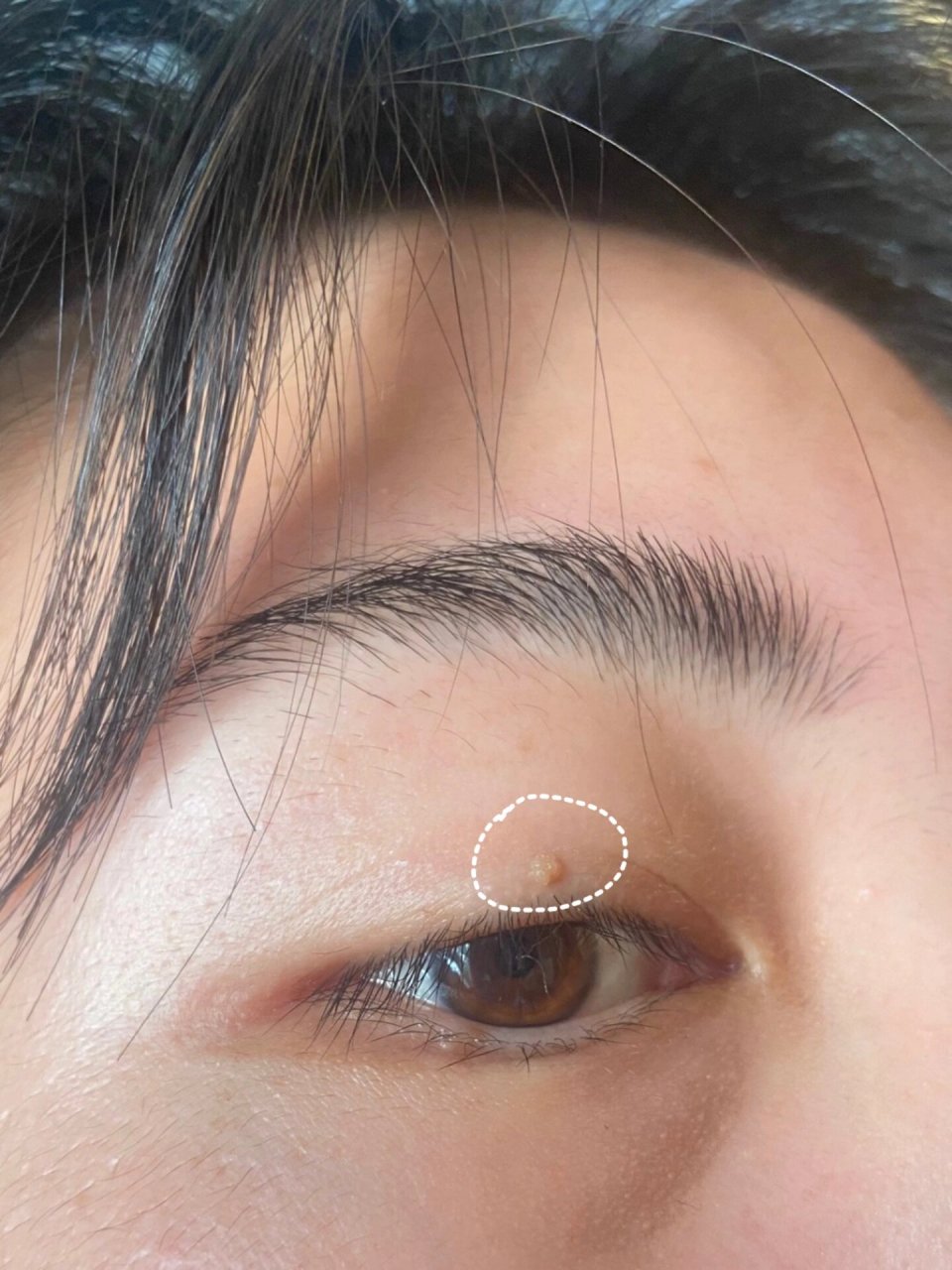 脸上长这个的姐妹!真的要小心了!