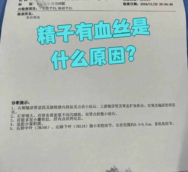 精子带血丝在医学上称为血精,最常见的原因是泌尿生殖系统炎症