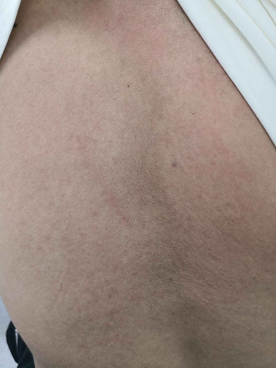 全身泛发色素沉着过度症状#黑变病##色素沉着