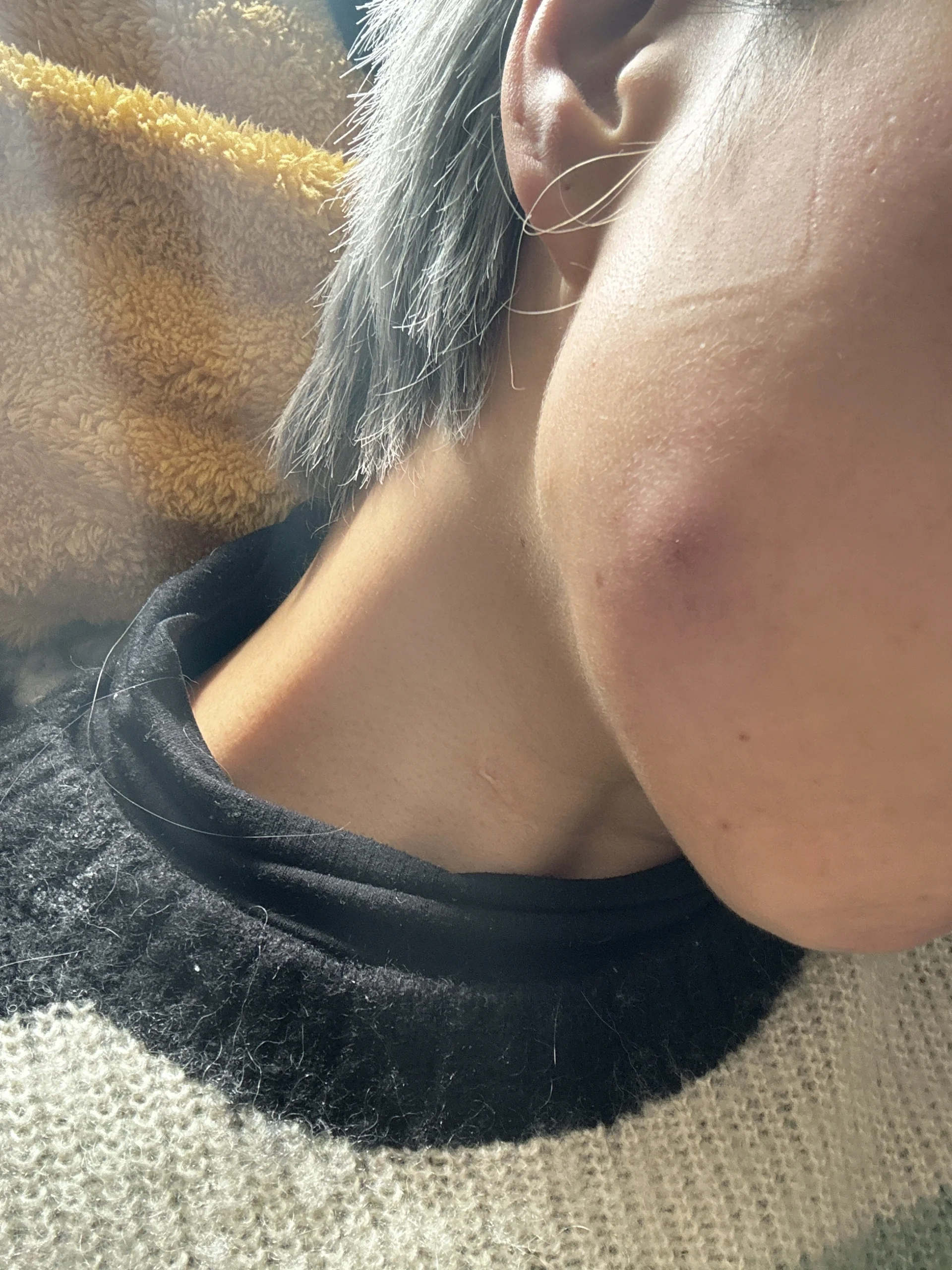 后来开始红肿,去了皮肤病医院说下可能皮下囊肿破了发炎