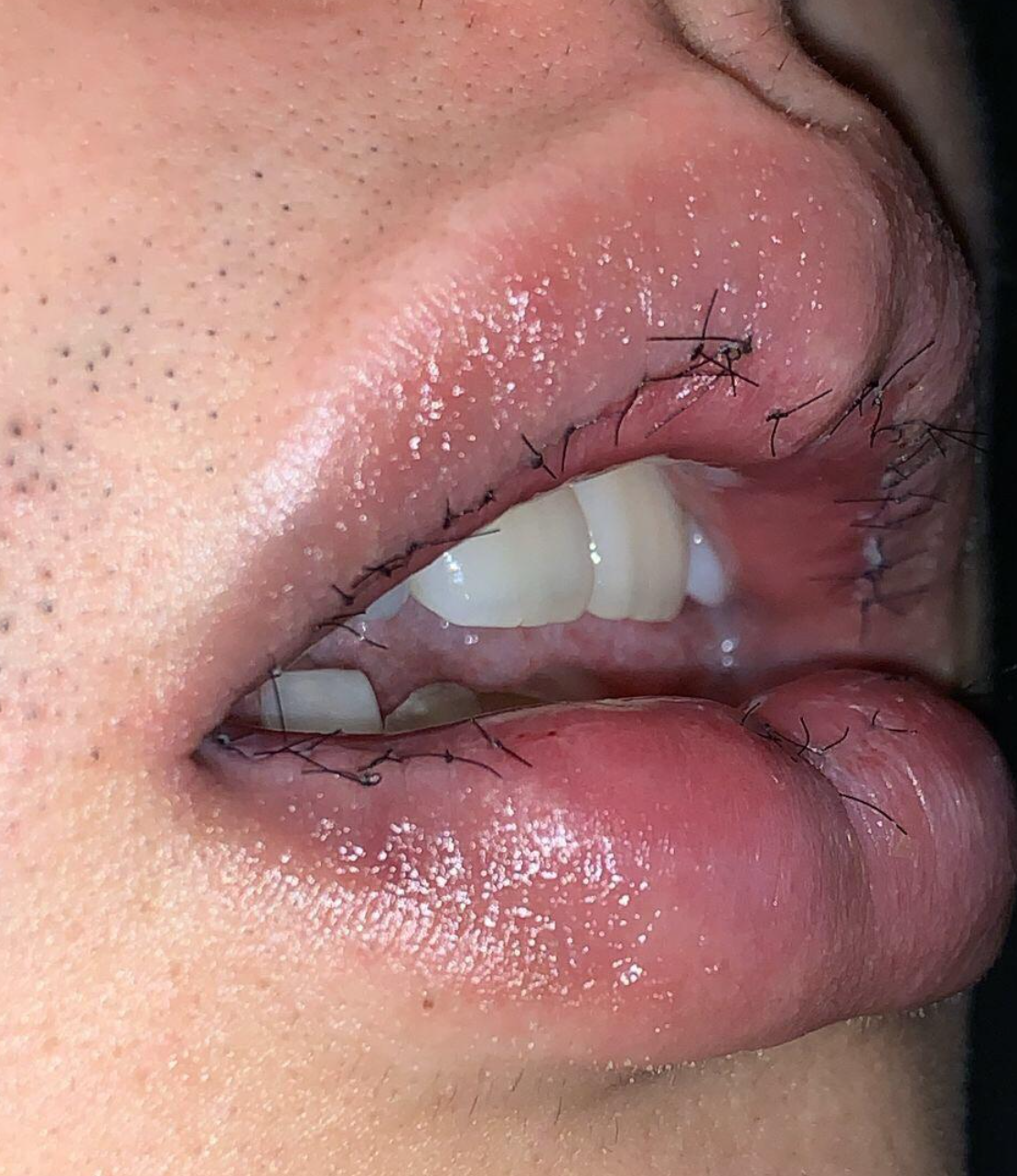 嘴唇厚有什么变薄的小窍门?