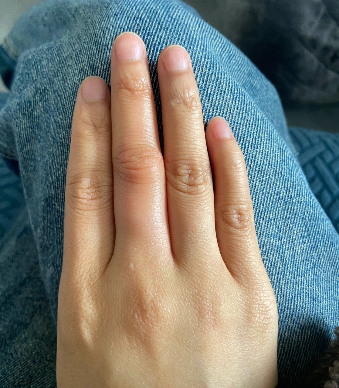 手指这两个关节突然又肿又痒 这是怎么了