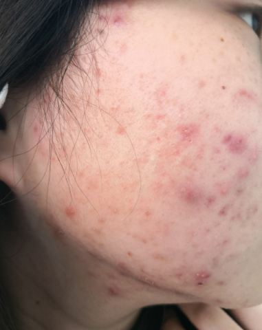 下颌角长痘痘红肿硬硬的还疼是什么原因导致的?