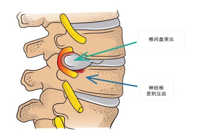 腰椎间盘突出症 神经根问题  生病初期