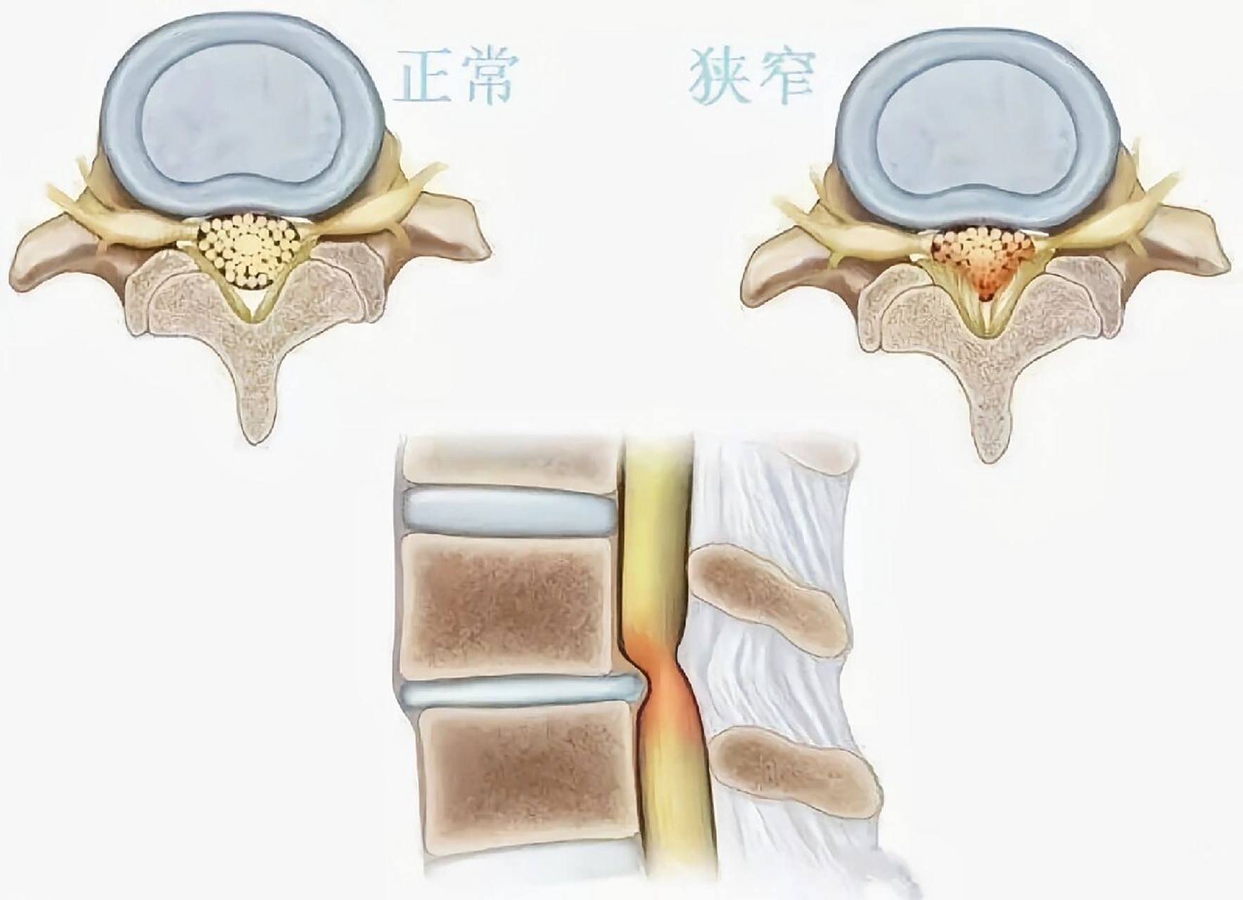胸椎管狭窄会有哪些临床表现呢?